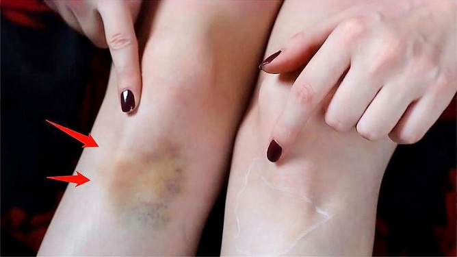 女生为什么容易淤青女生为什么容易淤青，探究生理因素与健康问题